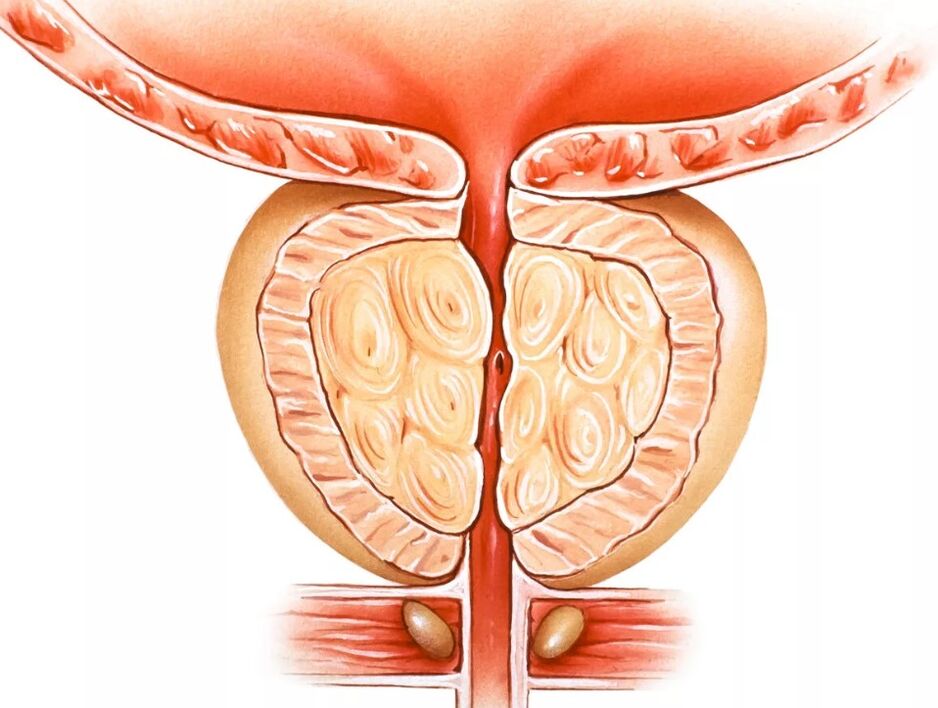 Prostatit