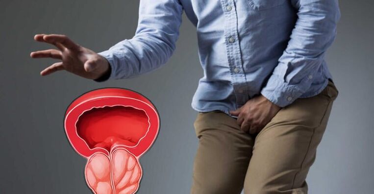 Prostatitning oldini olish va prostate Adenoma