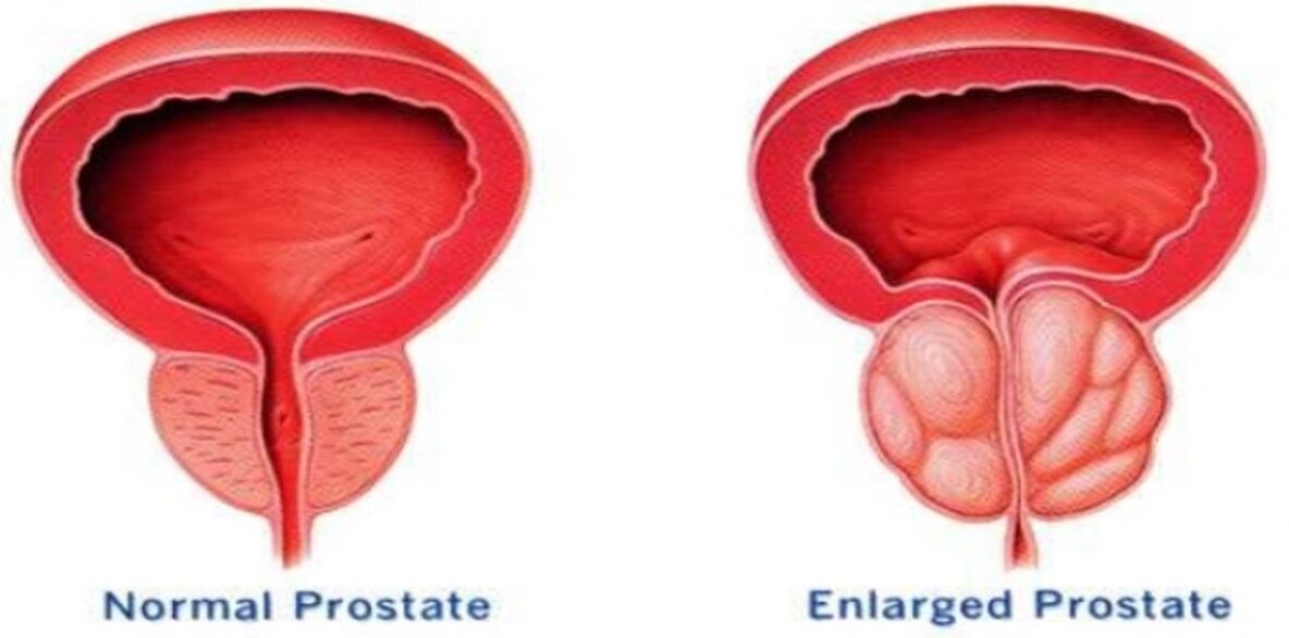 Normal prostata, yallig'langan prostata